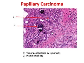 Papillary Carcinoma

1


    2




         1) Tumor papillae lined by tumor cells
         2) Psammoma body
 
