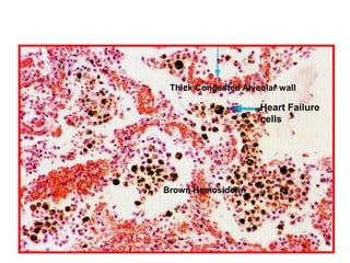 14- Chronic Venous Congestion, Lung
             High Power


                Thick Congested Alveolar wall

                                    Heart Failure
                                    cells




               Brown Hemosiderin
 