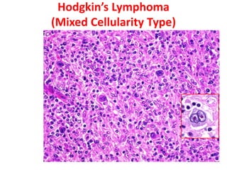 Hodgkin’s Lymphoma
(Mixed Cellularity Type)
 