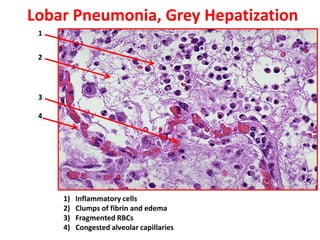Lobar Pneumonia, Grey Hepatization
 1


 2




 3

 4




     1)   Inflammatory cells
     2)   Clumps of fibrin and edema
     3)   Fragmented RBCs
     4)   Congested alveolar capillaries
 