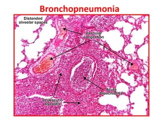 Bronchopneumonia
 