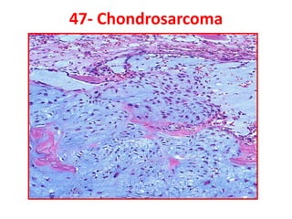 47- Chondrosarcoma
 