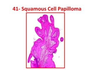 41- Squamous Cell Papilloma
 