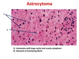 Astrocytoma
1




    2




        1) Astrocytes with large nuclei and scanty cytoplasm
        2) Network of interlacing fibrils
 