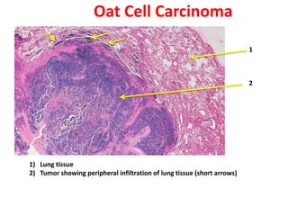 Oat Cell Carcinoma
                                                                         1



                                                                         2




1) Lung tissue
2) Tumor showing peripheral infiltration of lung tissue (short arrows)
 