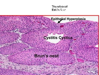 30- Bilhaarziasis Transitional Bladder
                  . Urinary
         EpithelialEpithelium
                    Changes

                  Epithelial Hyperplasia




              Cystitis Cystica



         Brun’s nest
 