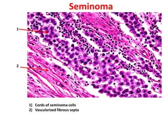 Seminoma

1




2




    1) Cords of seminoma cells
    2) Vascularized fibrous septa
 