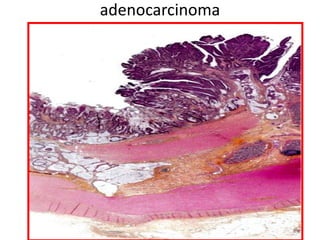 adenocarcinoma
 