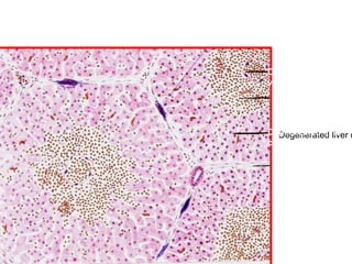15- Chronic Venous Congestion, liver
             (Diagram)
                             Congested Central
                             vein




                             Degenerated liver c
                                Degenerated liver
                             cells

                              Portal Tract
 