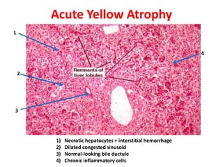 Acute Yellow Atrophy
1


                                                              4


    2




3




        1)   Necrotic hepatocytes + interstitial hemorrhage
        2)   Dilated congested sinusoid
        3)   Normal-looking bile ductule
        4)   Chronic inflammatory cells
 