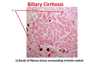 Biliary Cirrhosis
1




    1) Bands of fibrous tissue surrounding cirrhotic nodule
 