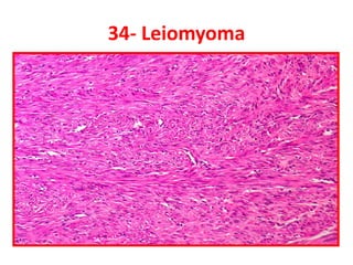 34- Leiomyoma
 