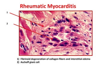 Rheumatic Myocarditis
1



2




    1) Fibrinoid degeneration of collagen fibers and interstitial edema
    2) Aschoff giant cell
 
