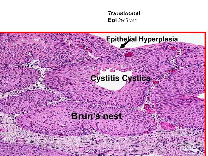 New practical histopathology tumor vs ulcer diagram 
