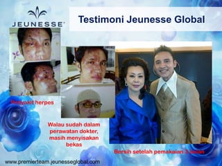 www.premierteam.jeunesseglobal.com
Testimoni Jeunesse Global
Penyakit herpes
Walau sudah dalam
perawatan dokter,
masih menyisakan
bekas
Bersih setelah pemakaian 3 bulan
 