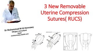 3 New Removable
Uterine Compression
Sutures( RUCS)
 