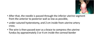 • After that, the needle is passed through the inferior uterine segment
from the anterior to posterior wall as low as possible,
• under sutured hysterotomy, and 2 cm inside from uterine artery
cross.
• The wire is then passed over as a brace to compress the uterine
fundus by approximately 3 or 4 cm inside the corneal border
 