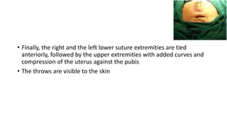 • Finally, the right and the left lower suture extremities are tied
anteriorly, followed by the upper extremities with added curves and
compression of the uterus against the pubis
• The throws are visible to the skin
 