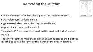 Removing the stitches
• The instruments used included a pair of laparoscopic scissors,
a 1-cm-diameter suction cannula,
a gynaecological contraceptive ring removal hook,
a spool of silk thread and a scalpel.
Two parallel ‘–’ incisions were made at the head and end of suction
cannula.
The length from the mark made on the scissor handle to the tip of the
scissor blades was the same as the length of the suction cannula.
 