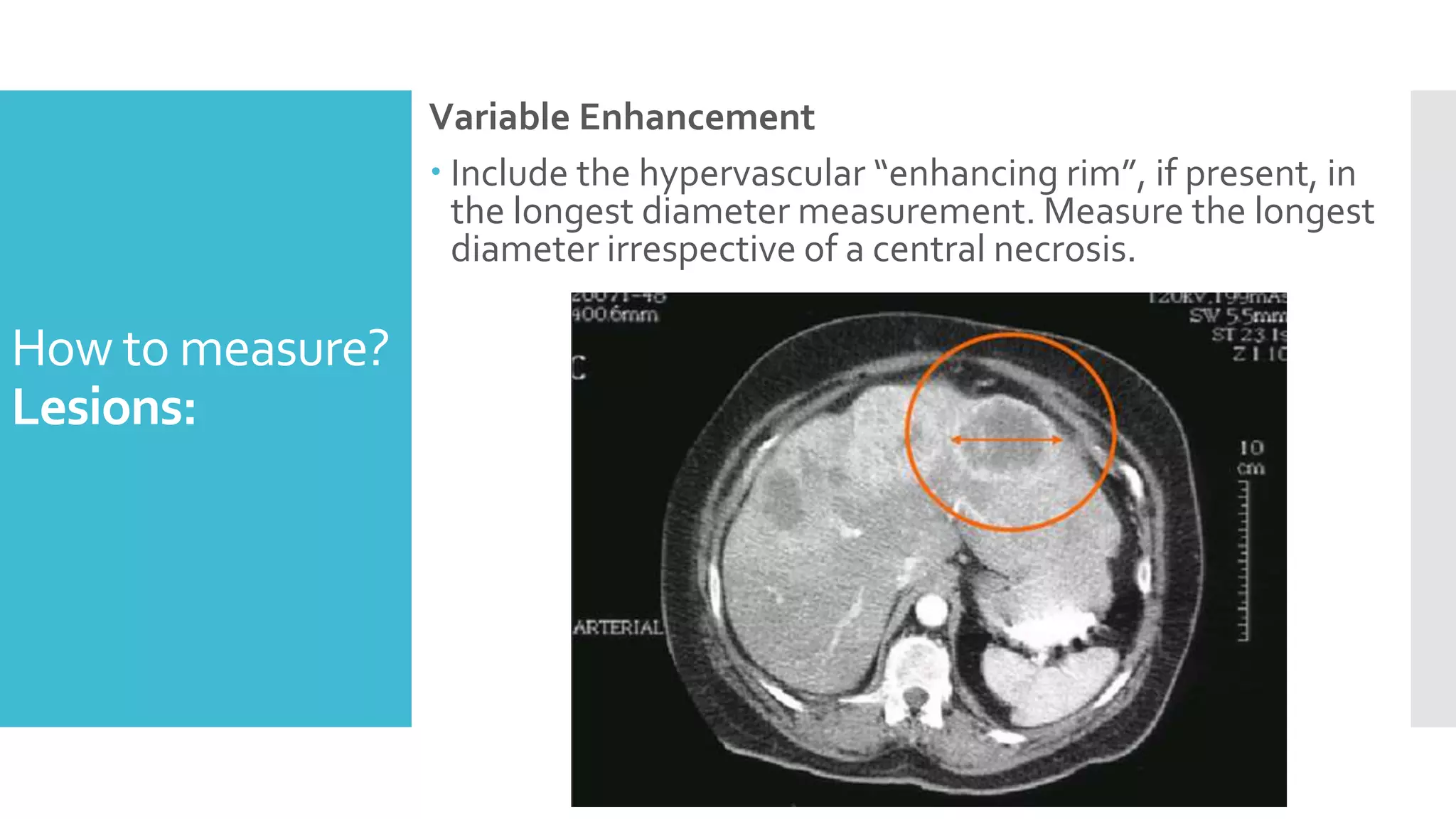 Variable Enhancement
 Include the hypervascular “enhancing rim”, if present, in
the longest diameter measurement. Measure the longest
diameter irrespective of a central necrosis.
How to measure?
Lesions:
 