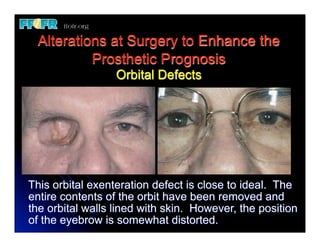 (New) restoration of facial defects basic priniciples | PDF