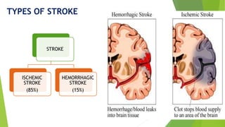 Seminar on clinical aspects of stroke | PPTX
