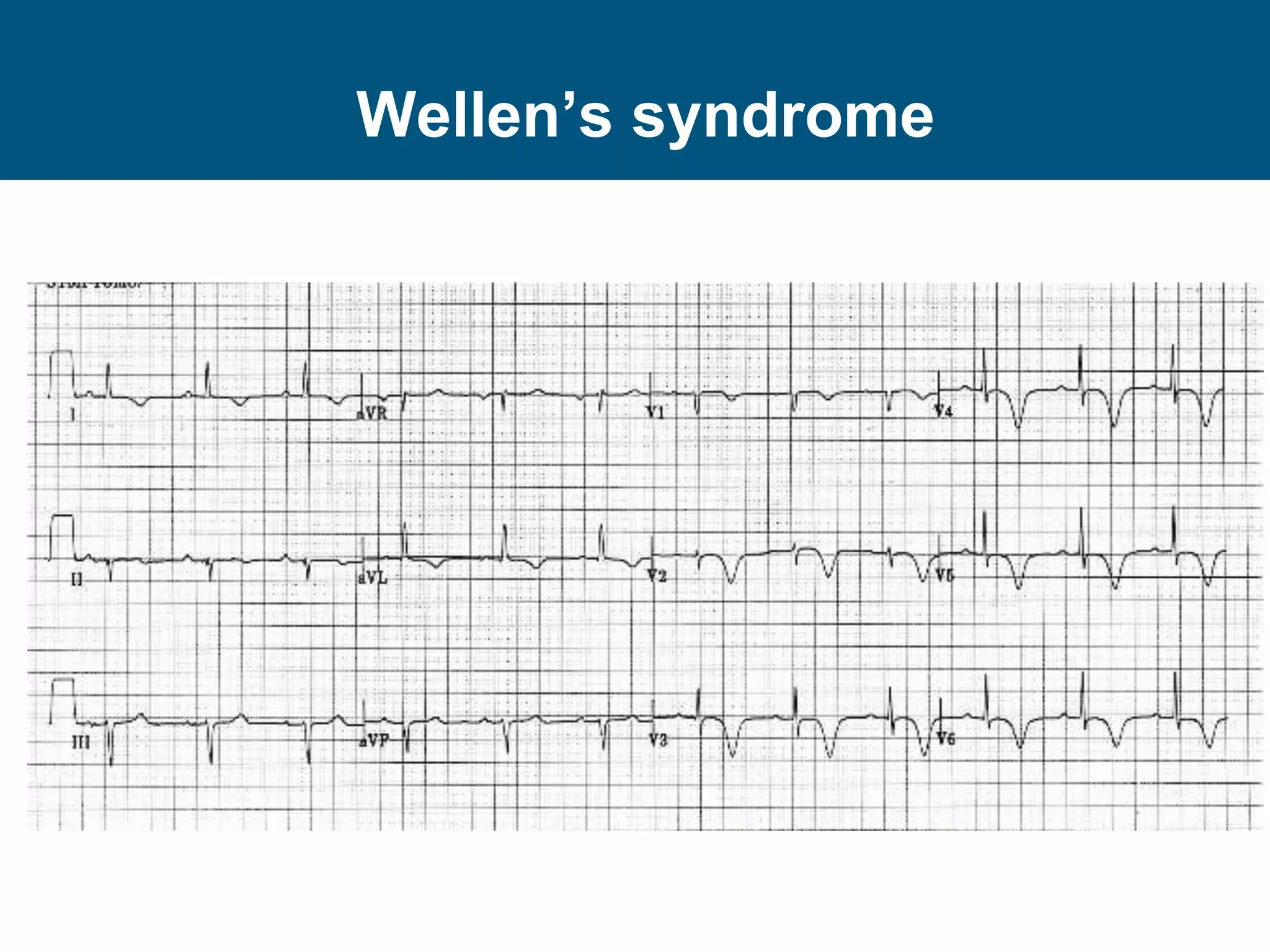 Wellen’s syndrome
 