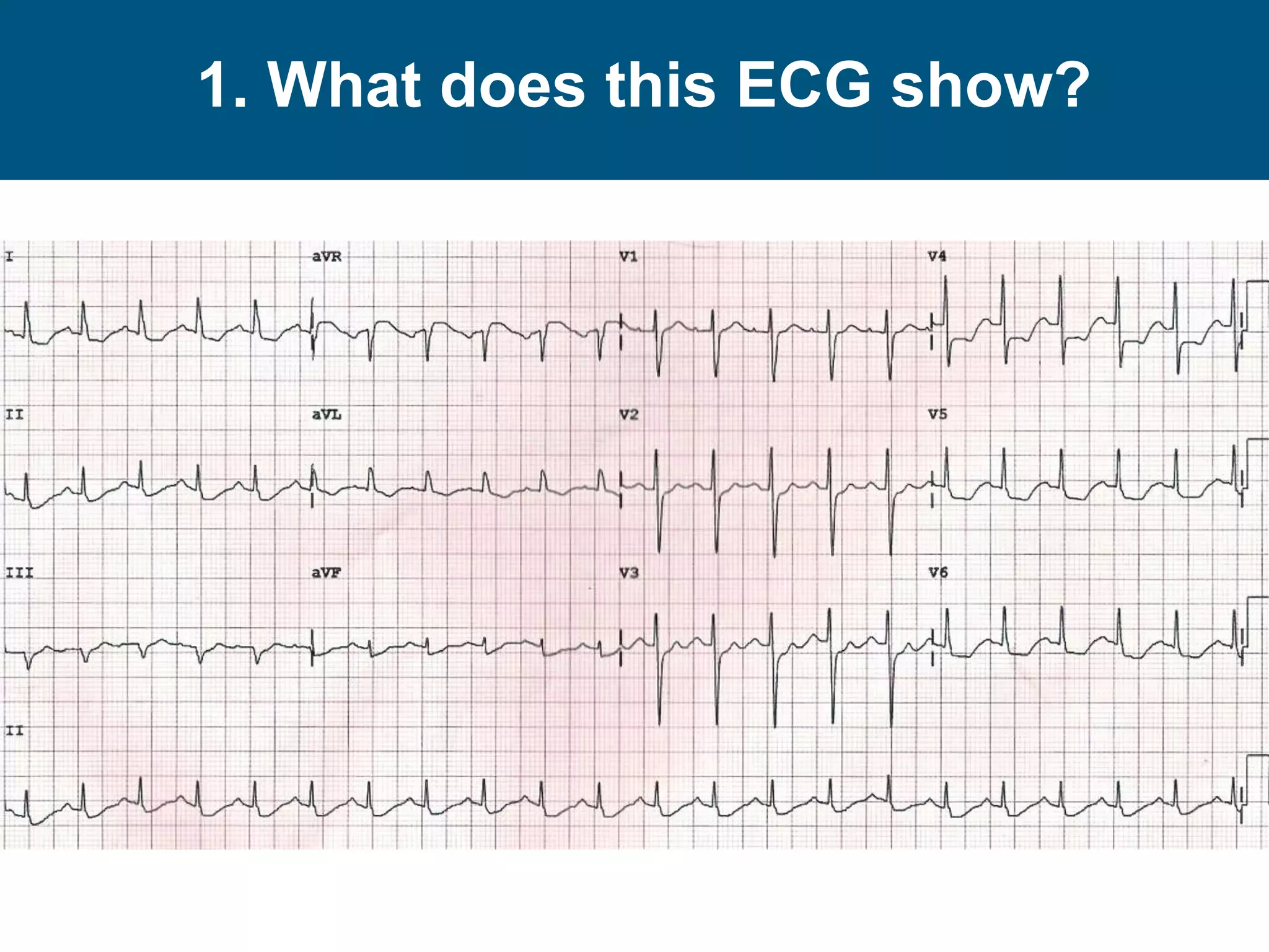 1. What does this ECG show?
 