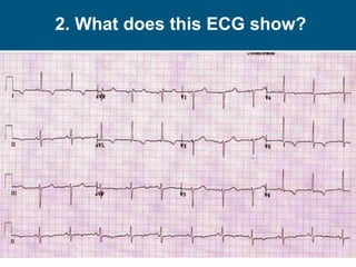 2. What does this ECG show?
 