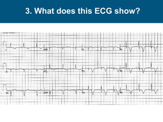 3. What does this ECG show?
 