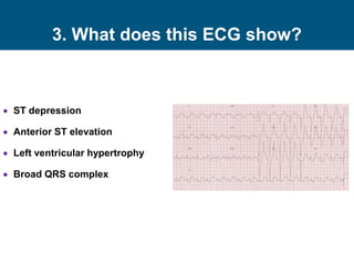  ST depression
 Anterior ST elevation
 Left ventricular hypertrophy
 Broad QRS complex
3. What does this ECG show?
 