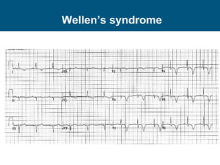 Wellen’s syndrome
 
