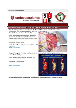 Endovascular - Newsletter I/2015
FÓRUM MÉDICO ENDOVASCULAR: CASOS DESTACADOS DEL MES
High Flow Iatrogenic Arteriovenous Fistula after Brachial Artery Puncture for Iliac Intervention
Autores: Xiaoyi Teng, MD,a Mireille A Moise, MD,b Lisa
Mican, RVT,a Javier A Alvarez- Tostado, MDa
Centro: Department of Vascular Surgery, Marymount
Hospital, Cleveland Clinic,a and the Department of
Vascular Surgery, Metrohealth Medical Center.b, EEUU
Especialidad: Cirugía Vascular
Fuente: Revista Técnicas Endovasculares, Volumen XVII
- Número 3
Leer el post completo.
Two-year Pythagoras US Pivotal Trial Results for the Aorfix device in Highly Angulated Aortic Necks
Autores: Dr. Mark Fillinger
Centro: Geisel School of Medicine, Dartmouth, EEUU
Especialidad: Cirugía Vascular
Leer el post completo.
Aortic athero-thrombotic formation that morphologically and clinically mimics an Aortic sarcoma
 