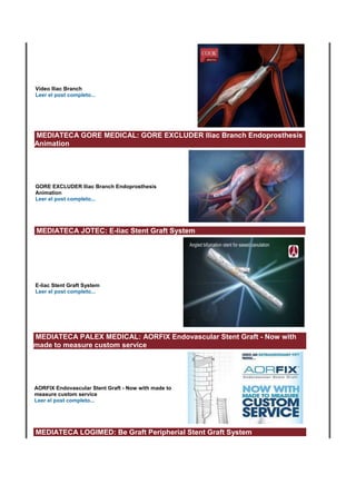 Vídeo Iliac Branch
Leer el post completo...
MEDIATECA GORE MEDICAL: GORE EXCLUDER Iliac Branch Endoprosthesis
Animation
GORE EXCLUDER Iliac Branch Endoprosthesis
Animation
Leer el post completo...
MEDIATECA JOTEC: E-liac Stent Graft System
E-liac Stent Graft System
Leer el post completo...
MEDIATECA PALEX MEDICAL: AORFIX Endovascular Stent Graft - Now with
made to measure custom service
AORFIX Endovascular Stent Graft - Now with made to
measure custom service
Leer el post completo...
MEDIATECA LOGIMED: Be Graft Peripherial Stent Graft System
 