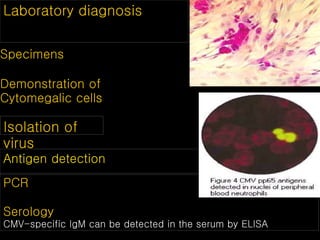 Laboratory diagnosis
Specimens
Demonstration of
Cytomegalic cells
Isolation of
virus
Antigen detection
PCR
Serology
CMV-specific IgM can be detected in the serum by ELISA
 