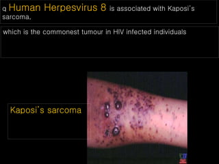 q Human Herpesvirus 8 is associated with Kaposi’s
sarcoma,
which is the commonest tumour in HIV infected individuals
Kaposi’s sarcoma
 