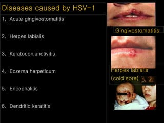 1. Acute gingivostomatitis
2. Herpes labialis
3. Keratoconjunctivitis
4. Eczema herpeticum
5. Encephalitis
6. Dendritic keratitis
Diseases caused by HSV-1
Gingivostomatitis
Herpes labialis
(cold sore)
 