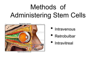 Methods of
Administering Stem Cells
• Intravenous
• Retrobulbar
• Intravitreal
 