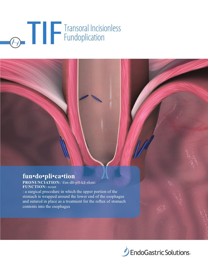 New Transoral Fundoplication Brochure