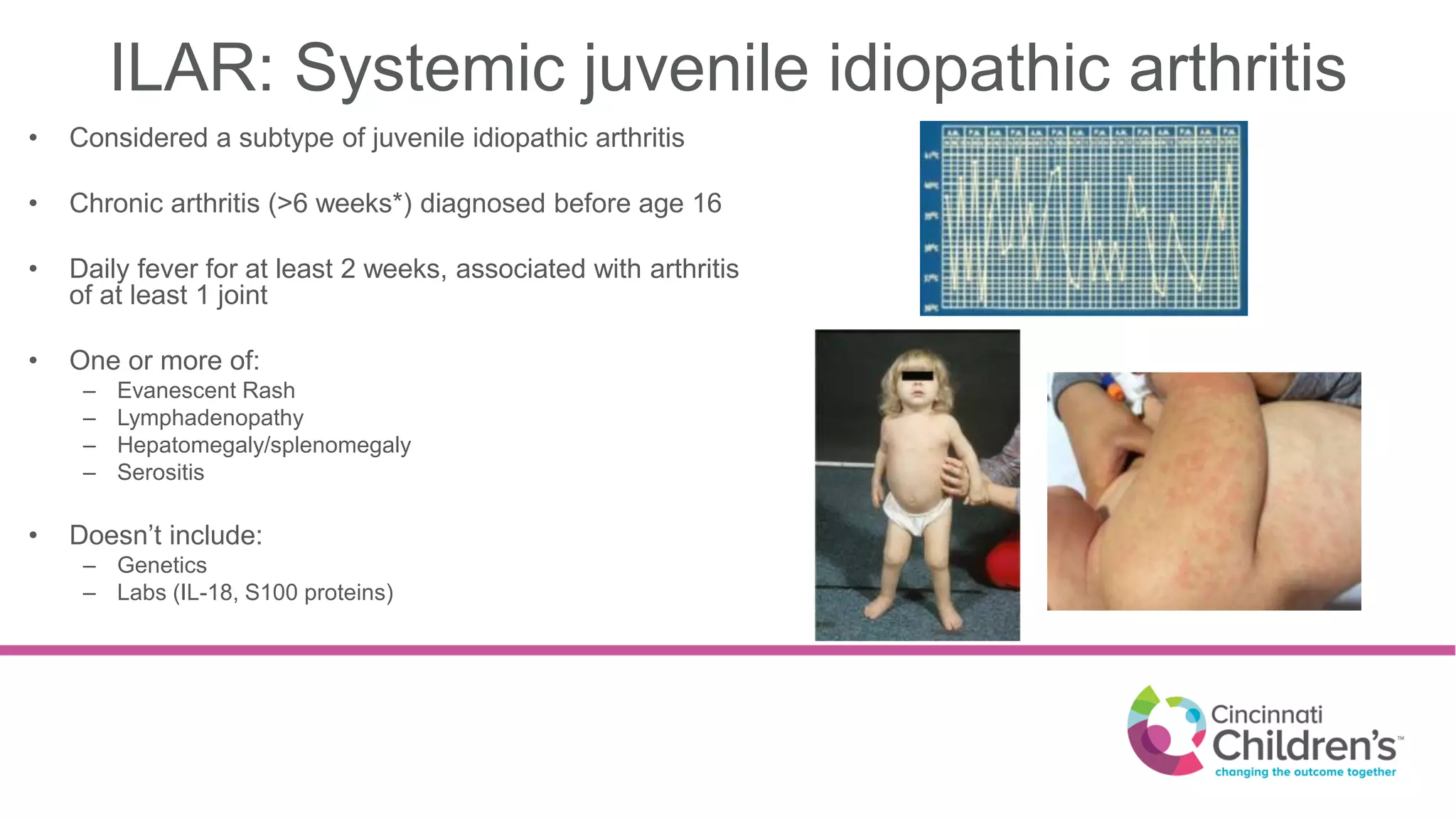 New Treatments for SJIA | PPTX