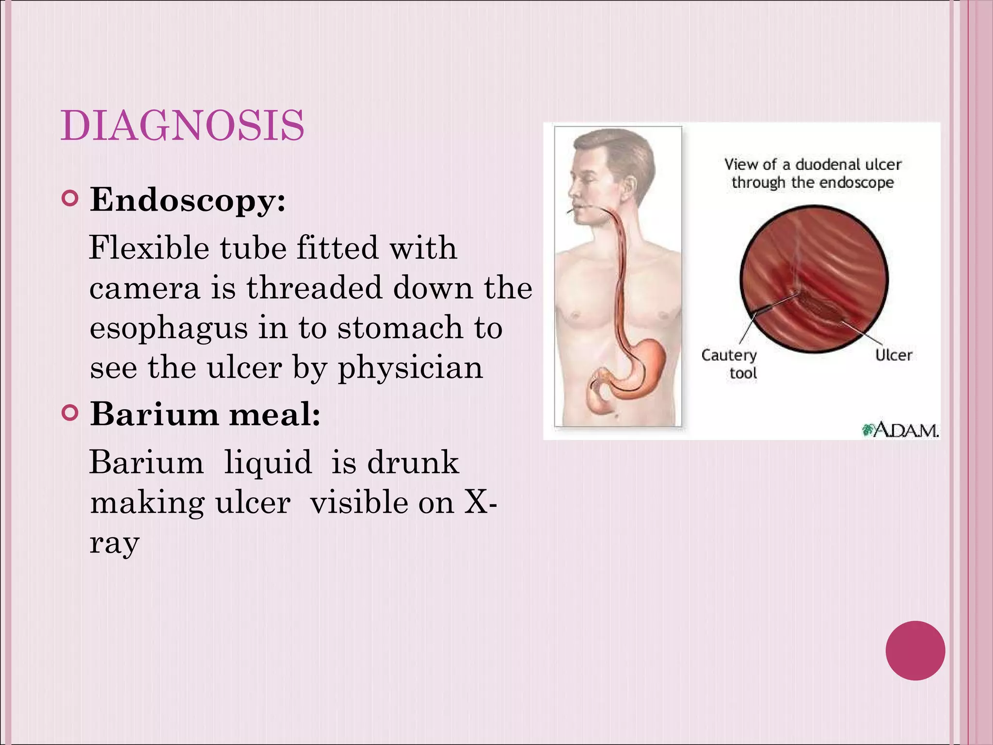 DIAGNOSIS Endoscopy: Flexible tube fitted with camera is threaded down the esophagus in to stomach to see the ulcer by physician Barium meal: Barium   liquid   is drunk making ulcer  visible on X-ray 