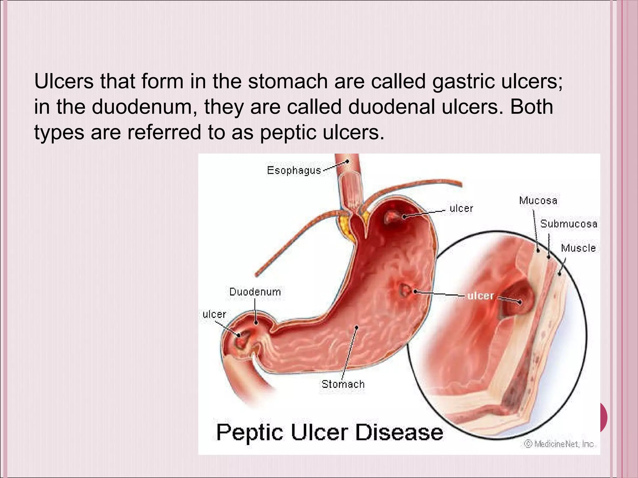 Ulcers that form in the stomach are called gastric ulcers; in the duodenum, they are called duodenal ulcers. Both types are referred to as peptic ulcers. 