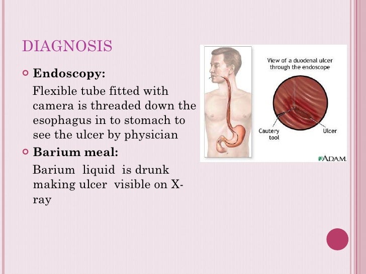 peptic ulcer