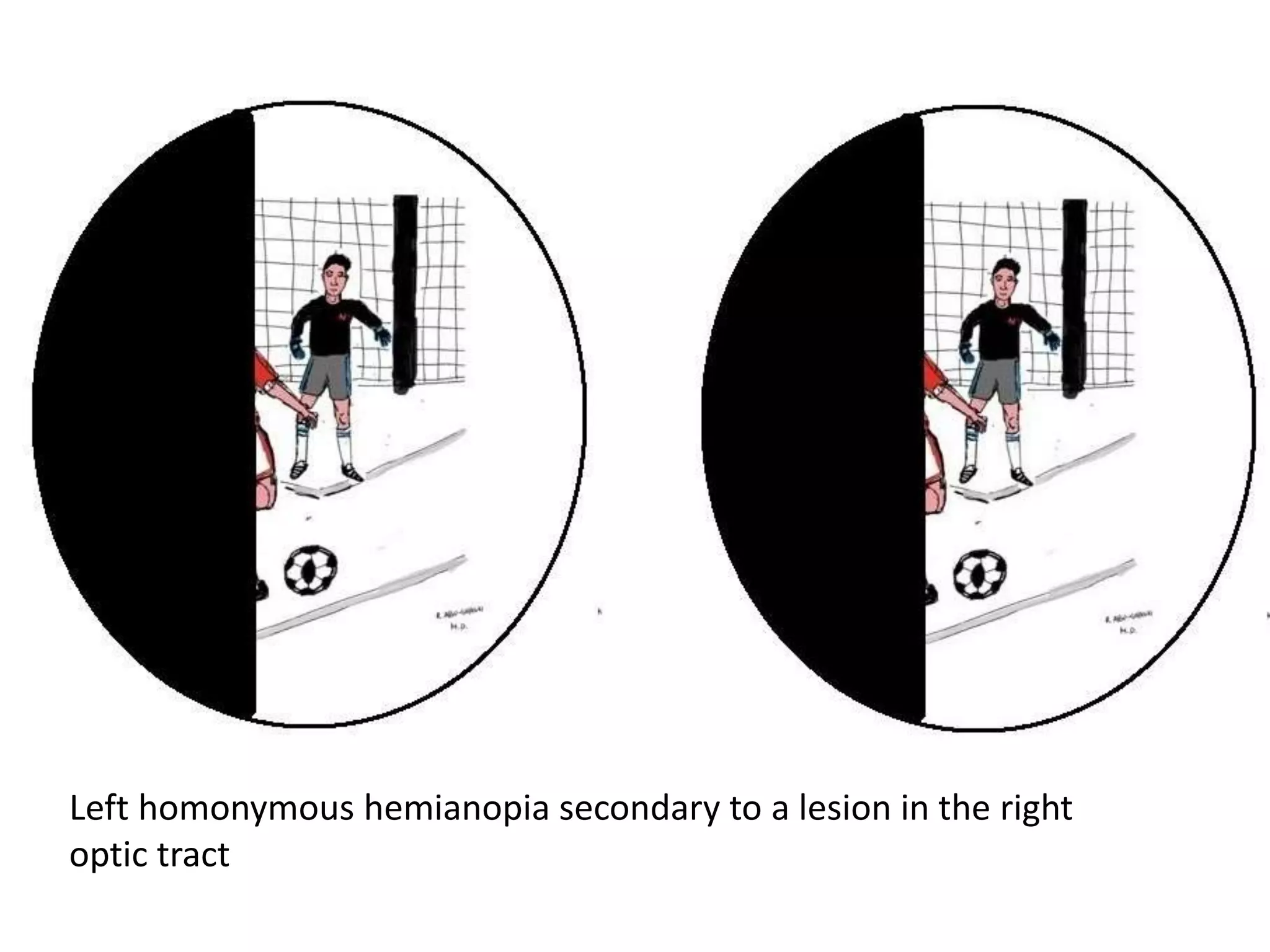 Visual Field Defects | PPTX