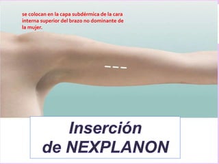 se colocan en la capa subdérmica de la cara
interna superior del brazo no dominante de
la mujer.
 