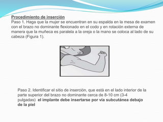 Procedimiento de inserción
Paso 1. Haga que la mujer se encuentran en su espalda en la mesa de examen
con el brazo no dominante flexionado en el codo y en rotación externa de
manera que la muñeca es paralela a la oreja o la mano se coloca al lado de su
cabeza (Figura 1).
Paso 2. Identificar el sitio de inserción, que está en el lado interior de la
parte superior del brazo no dominante cerca de 8-10 cm (3-4
pulgadas) el implante debe insertarse por vía subcutánea debajo
de la piel
 