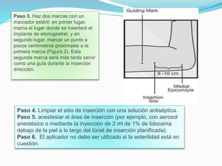 Paso 3. Haz dos marcas con un
marcador estéril: en primer lugar,
marca el lugar donde se insertará el
implante de etonogestrel, y en
segundo lugar, marcar un punto a
pocos centímetros proximales a la
primera marca (Figura 2). Esta
segunda marca será más tarde servir
como una guía durante la inserción
dirección.
Paso 4. Limpiar el sitio de inserción con una solución antiséptica.
Paso 5. anestesiar el área de inserción (por ejemplo, con aerosol
anestésico o mediante la inyección de 2 ml de 1% de lidocaína
debajo de la piel a lo largo del túnel de inserción planificada).
Paso 6. El aplicador no debe ser utilizado si la esterilidad está en
cuestión.
 