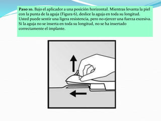 Paso 10. Bajo el aplicador a una posición horizontal. Mientras levanta la piel
con la punta de la aguja (Figura 6), deslice la aguja en toda su longitud.
Usted puede sentir una ligera resistencia, pero no ejercer una fuerza excesiva.
Si la aguja no se inserta en toda su longitud, no se ha insertado
correctamente el implante.
 