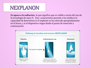 Es opaco a la radiación, lo que significa que es visible a través del uso de
la tecnología de rayos X. Esta característica permite a los médicos la
capacidad de determinar si el implante se ha colocado apropiadamente
en el brazo, y si el dispositivo migra desde el punto de inserción a
continuación.
 