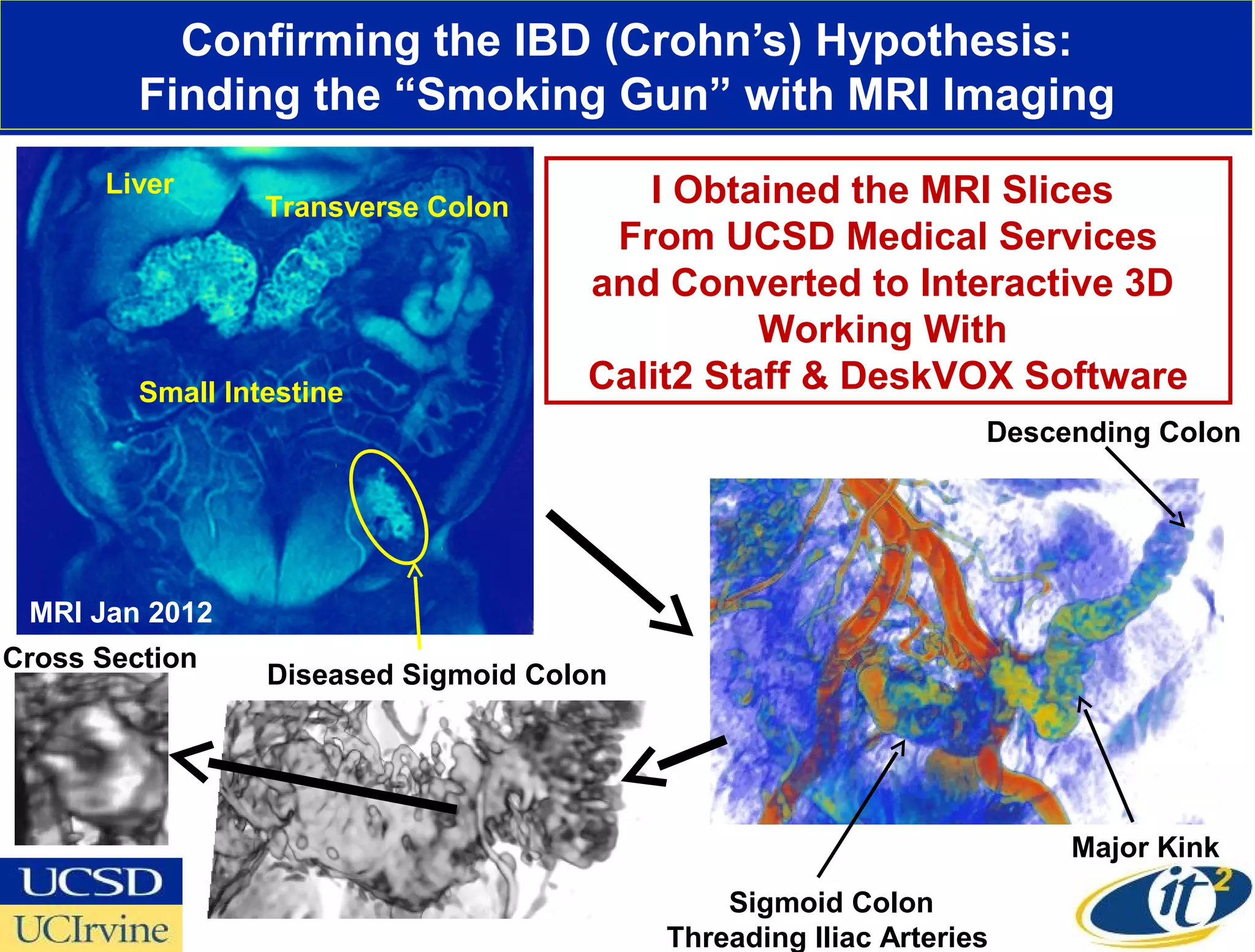 Confirming the IBD (Crohn’s) Hypothesis:
         Finding the “Smoking Gun” with MRI Imaging
      Liver                              I Obtained the MRI Slices
                  Transverse Colon
                                       From UCSD Medical Services
                                      and Converted to Interactive 3D
                                                Working With
         Small Intestine              Calit2 Staff & DeskVOX Software
                                                                  Descending Colon




 MRI Jan 2012
Cross Section
                  Diseased Sigmoid Colon




                                                                       Major Kink
                                               Sigmoid Colon
                                           Threading Iliac Arteries
 